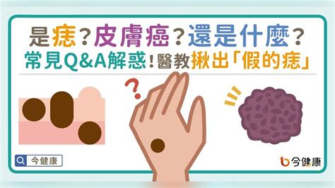 臉頰長痣代表什麼|是痣？皮膚癌？還是什麼？常見Q&A解惑！醫教揪出「。